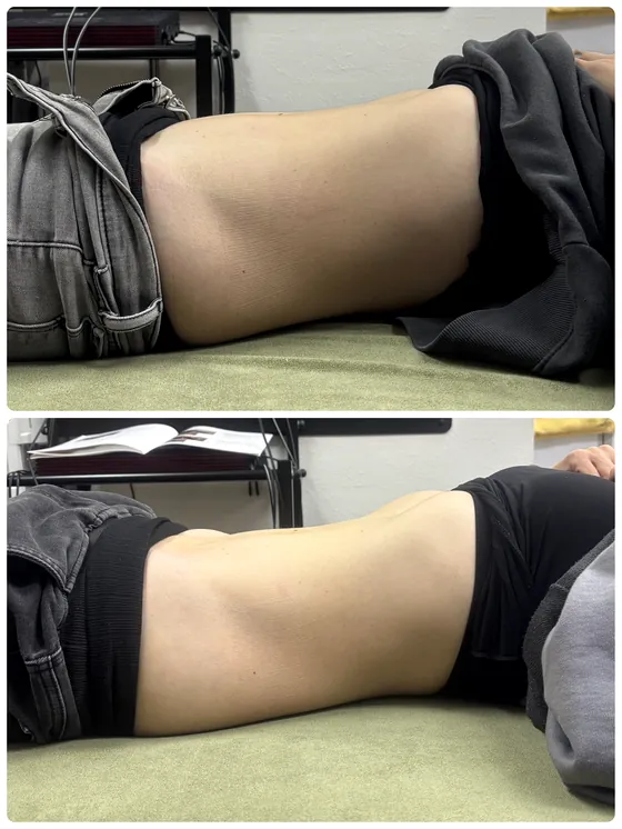 腸もみ 施術前後のお腹まわり その1